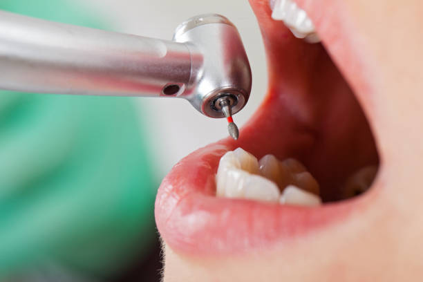 Best Emergency Root Canal Treatment in Perkins, OK